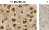 Clin Cancer Res & JCO：一种新型的基于RNA的疗法或有望治疗对靶向药物耐受的人类肾脏癌症