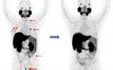 PET示踪剂可能改善前列腺癌成像