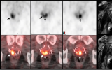 新型PET放射性示踪剂可否成为多参数MRI的可行替代方案，检测前列腺癌复发？